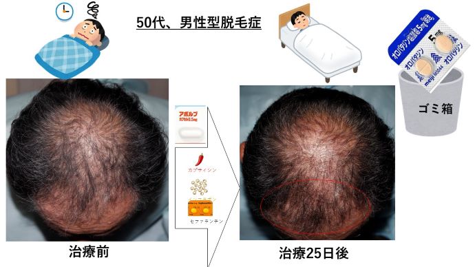 円形脱毛症　病院